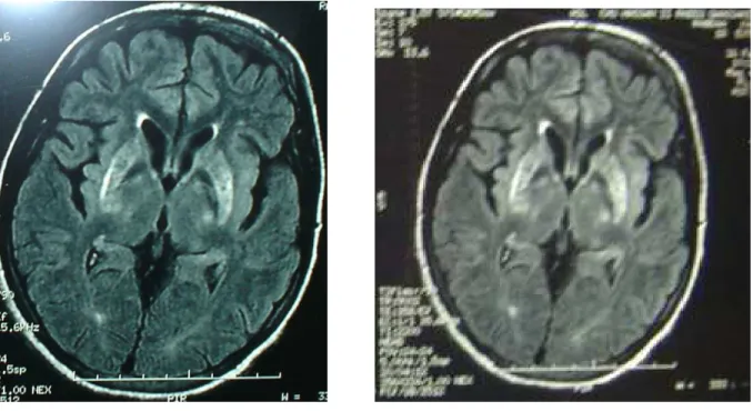 Figure 2 :  IRM cérébrale en coupe axiale  FLAIR ne montre pas d'anomalie 