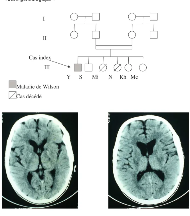 Figure 3: TDM cérébrale en coupe axiale montrant (3 &gt;=/5 +7 5 5 *E =*721 29 0 278/= + 0/87+0/