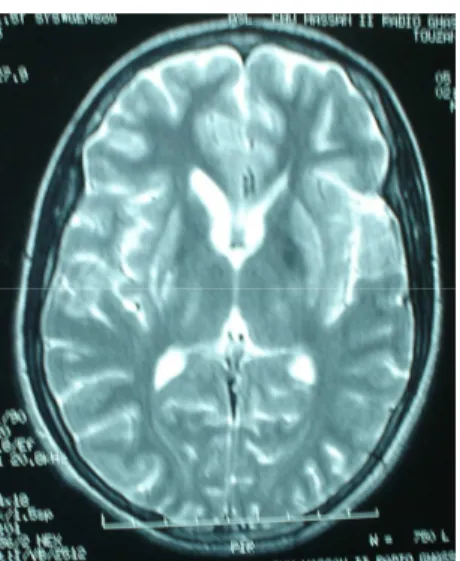Figure  4 :    coupe  axiale  d'IRM  cérébrale  en  séquence    montrant 5 &gt;= 8 +; 2*E + 7 8 2 7 ( =*721 7 ( (/0* +; 8 