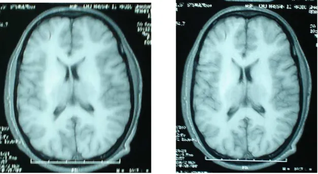 Figure  8 :    coupes  axiales  d'IRM  cérébrales  en  séquence  T1  ne  montrant  pas  d'anomalies