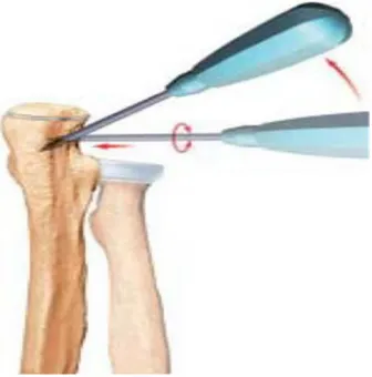 Figure 12 [17].  Introduction de la broche : 