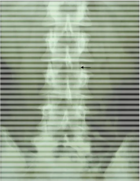 Figure 10: Radiographie standard du rachis lombaire de face montrant une  sagittalisation des articulaires  (flèche noire) avec diminution de l’espace 