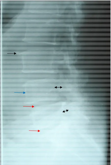 Figure 12: Radiographie standard du rachis lombaire de profil montrant un  spondylolisthésis L4-L5 grade I (flèche bleue), une ostéophytose antérieure  étagée (flèche noire) , une brièveté pédiculaire (double flèche noire) et un 