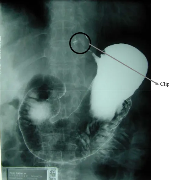 Figure 3 : Image radiologique d’un estomac normal opacifié avec 