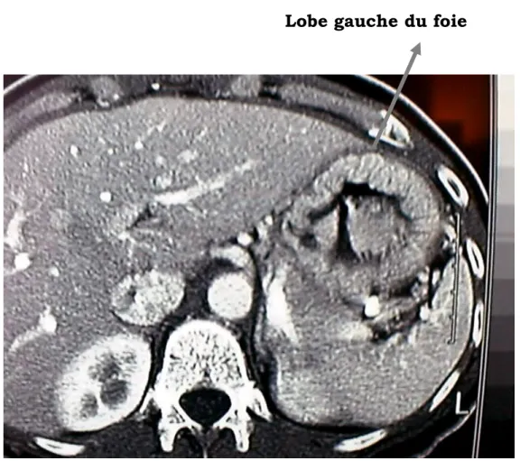 Figure 4 : Image tomodensitométrique montrant les rapports de la 