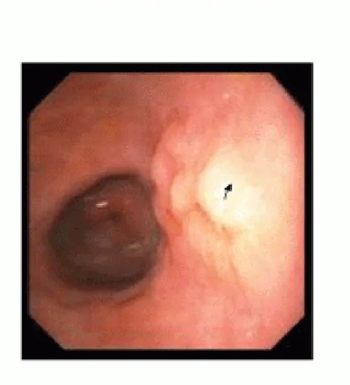 Figure 7 : Processus tumoral superficiel.  Réf :  [Atlas d’endoscopie digestive]. 