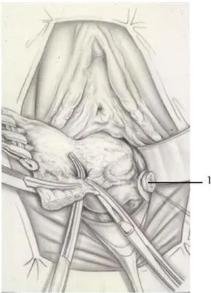 Figure 6: Ligature des vaisseaux cervico-vaginaux (1) après section du paramètre.(52) 