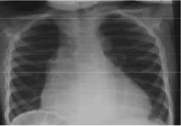 Figure 17 (16) : Radiographie thoracique d’un enfant de 5 ans atteint de syndrome 