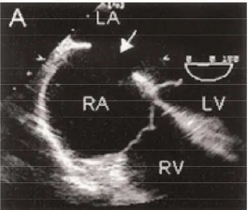 Figure 25 (20) : Vue en 4 cavités du massif auriculaire. CIA de type ostium 