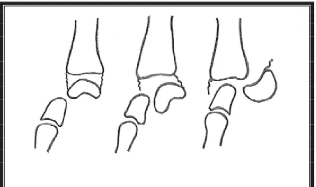Figure : Classification de Witvoët et Allieu. 
