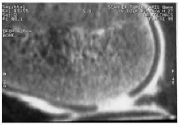 Figure 7 :  Arthroscanner du genou : coupe coronale: Erosion du cartilage  fémoral 