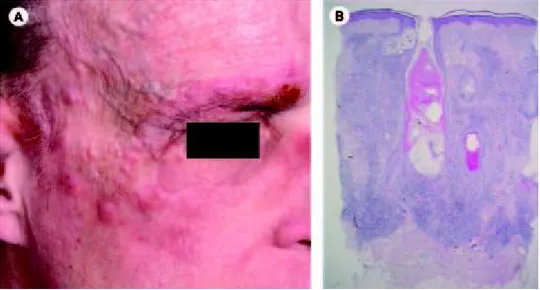 Figure 4. Mycosis fongoïde folliculaire [12]. (A) des plaques infiltrées sur le front et le sourcil droit avec  alopécie