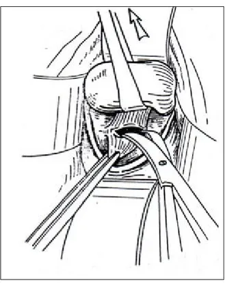 Figure 4-a : Incision vaginale postérieure et abord du cul-de-sac de Douglas. 