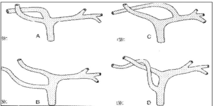 Figure    7: variations du confluent biliaire supérieur         