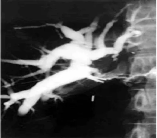 Figure    19 19 19    ::::     19 PTC montrant une haute et sévère sténose intéressant                                                                