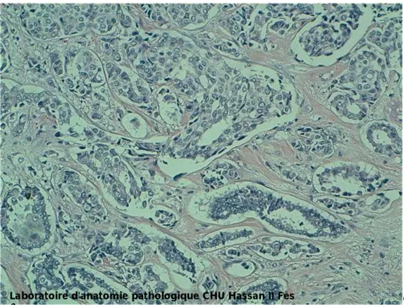 Figure 9 : carcinome canalaire infiltrant grade II de SBR (HES x400) 