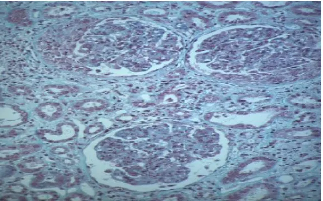 Figure 4 : glomérulonéphrite classe IV en microscope optique  (Kidney int 2004 ; 65 : 521-30) 