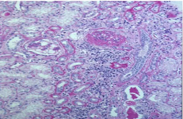 Figure 7 : glomérulonéphrite classe VI en microscope optique  (Kidney int 2004 ; 65 : 521-30) 