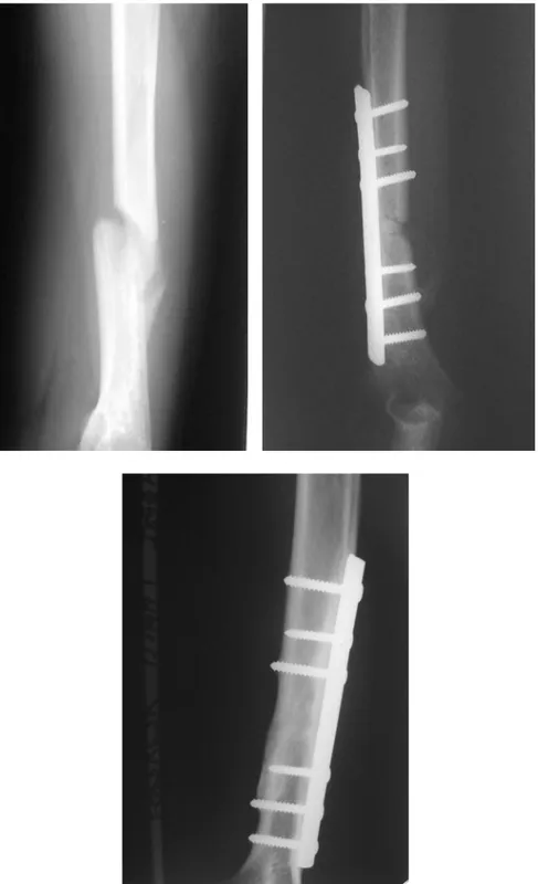 Figure III :  consolidation de pseudarthrose après  traitement par  plaque vissée + greffe cortico-spongieuse après un recul  de 18 mois (obsv