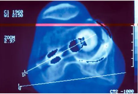 Figure 4 : Scanner de la hanche d'un patient opéré par voie postéro externe et ayant  présenté une instabilité récidivante antérieure de sa PTH