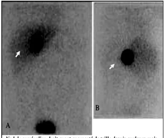 Figure 8 : phéochromocytome à la scintigraphie à la MIBG [35] 