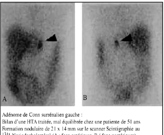 Figure 10 : adénome de CONN à la scintigraphie au Norchol* [35] 