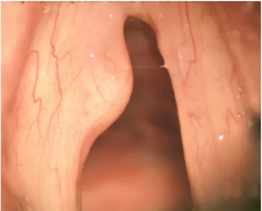 Figure 10 : Kyste muqueux de la corde vocale droite. (132) 
