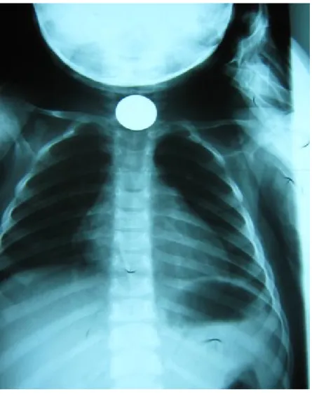 Figure 11 : Radiographie thoracique de face objectivant la présence d’une pièce de 