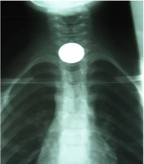Figure 12 : Radiographie thoracique de face visualisant la présence d’une pièce de 