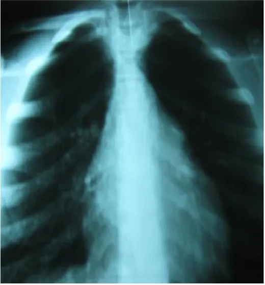 Figure 13 : Radiographie thoracique montrant la présence d’une aiguille au niveau 