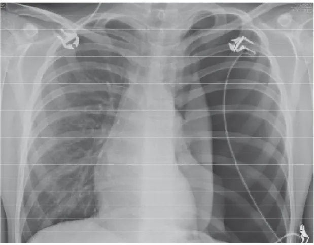 Fig1 :pneumothorax gauche de grande abondance. 