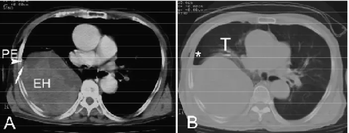 Figure  2 : [7] : coupes scannographiques montrant un hémothorax de grande  abondance