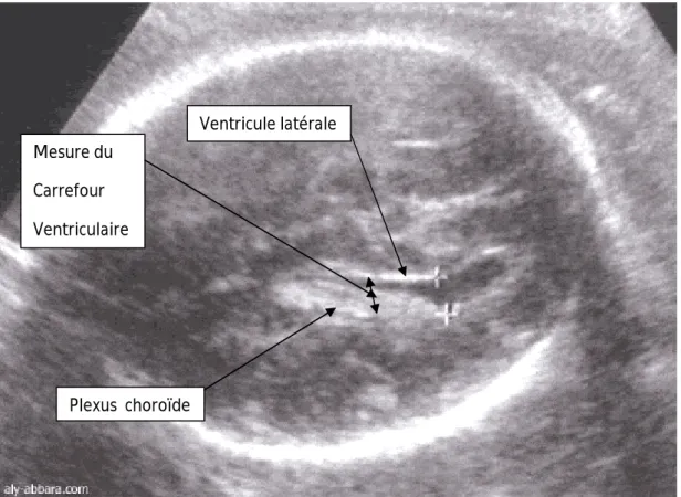 Figure 5 : Coupe transversale du cerveau fœtal à 28 SA : Carrefour ventriculaire  postérieure (140) Mesure du Carrefour Ventriculaire Ventricule latérale Plexus  choroïde 