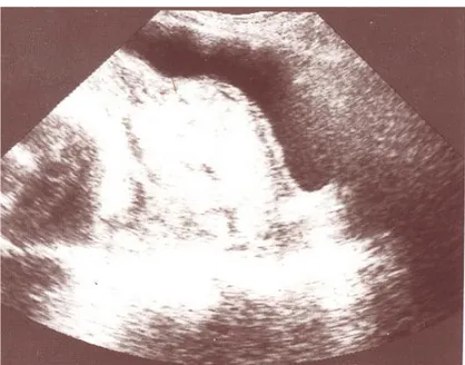 Figure 12: échographie 2D: aspect pseudo tumoral du placenta en regard de la 