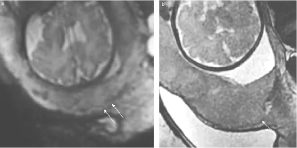 Figure 27 :Imagerie par résonance magnétique (IRM) : placenta praevia coupes 