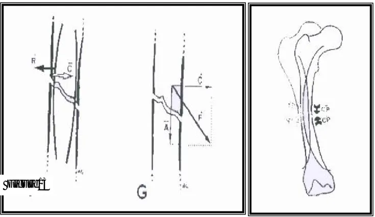 Figure 11: Toute force C perpendiculaire à l'axe de la diaphyse donc des broches, 