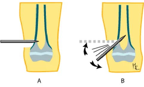 Figure 14 : Introduction des broches et guidage dans le canal médullaire. 