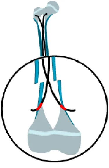 Figure 24:L'embrochage descendant assure une meilleure stabilité que l'ECMES 