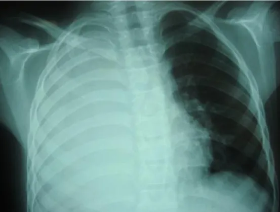 Figure 1 : radiographie de thorax face montrant un épanchement unilatéral de  grande abondance : poumon blanc, responsable d’un refoulement médiastinal vers 