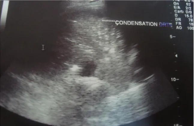 Figure 3 : coupe échographique transversale de la base thoracique chez un enfant  de 5ans : Epanchement pleural gauche avec condensation pulmonaire en regard