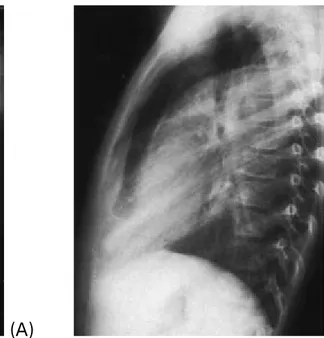 Figure 7 : pleurésie purulente à pneumocoque (1): 