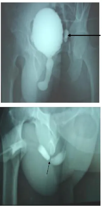 Fig. 6: UCRM d’un patient du service d’urologie du CHU HASSAN II.  Sténose serrée de l’urètre bulbaire avec dilatation de l’urètre d’amont et 