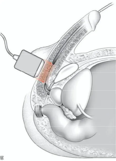 Fig. 7 : Sono-urètrographie[11] 