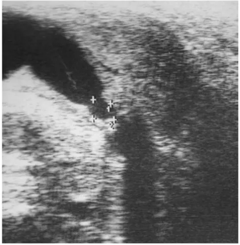 Fig. 9 : Fibrose du tissu spongieux [11] 