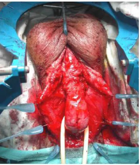 Fig. 13 : UTT dans l’urètre bulbaire ; Dissection de l’urètre sur un lacs 