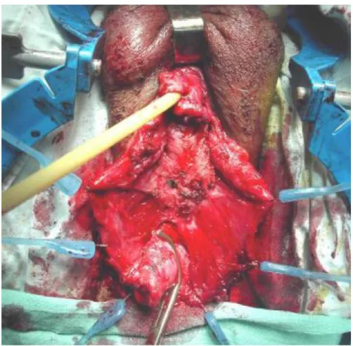 Fig. 14: UTT dans l’urètre bulbaire ; Incision de l’urètre à hauteur de la sténose 