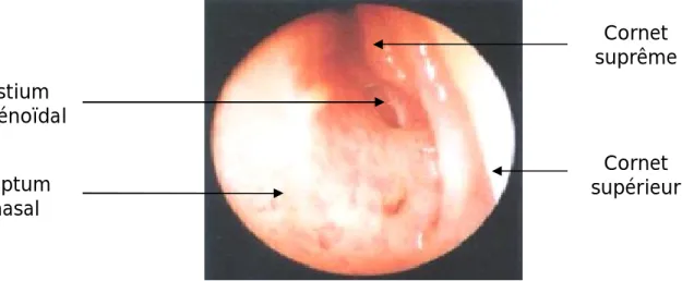 Figure 10: Vue endoscopique de la fosse nasale droite. 