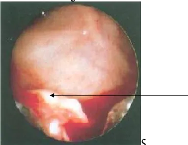 Figure 15: Sinuscopie maxillaire. (14) 