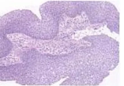 Figure  33 :  Papillome  inversé  de 