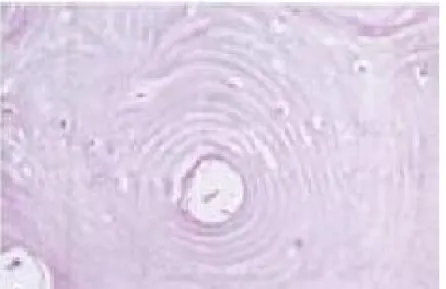 Figure  35 :  Ostéome  nasosinusien:  os  lamellaire  mature  avec  des  structures  ostéon-like (39)